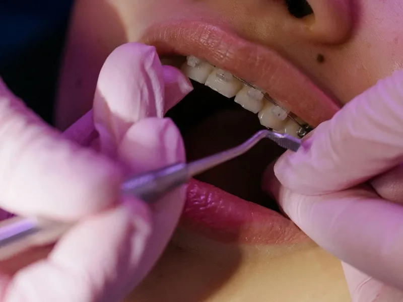 does medicaid cover braces in florida