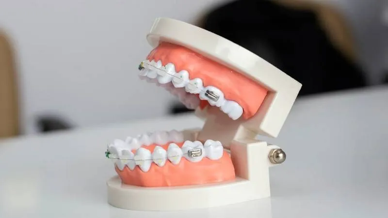 does medicaid cover braces 1