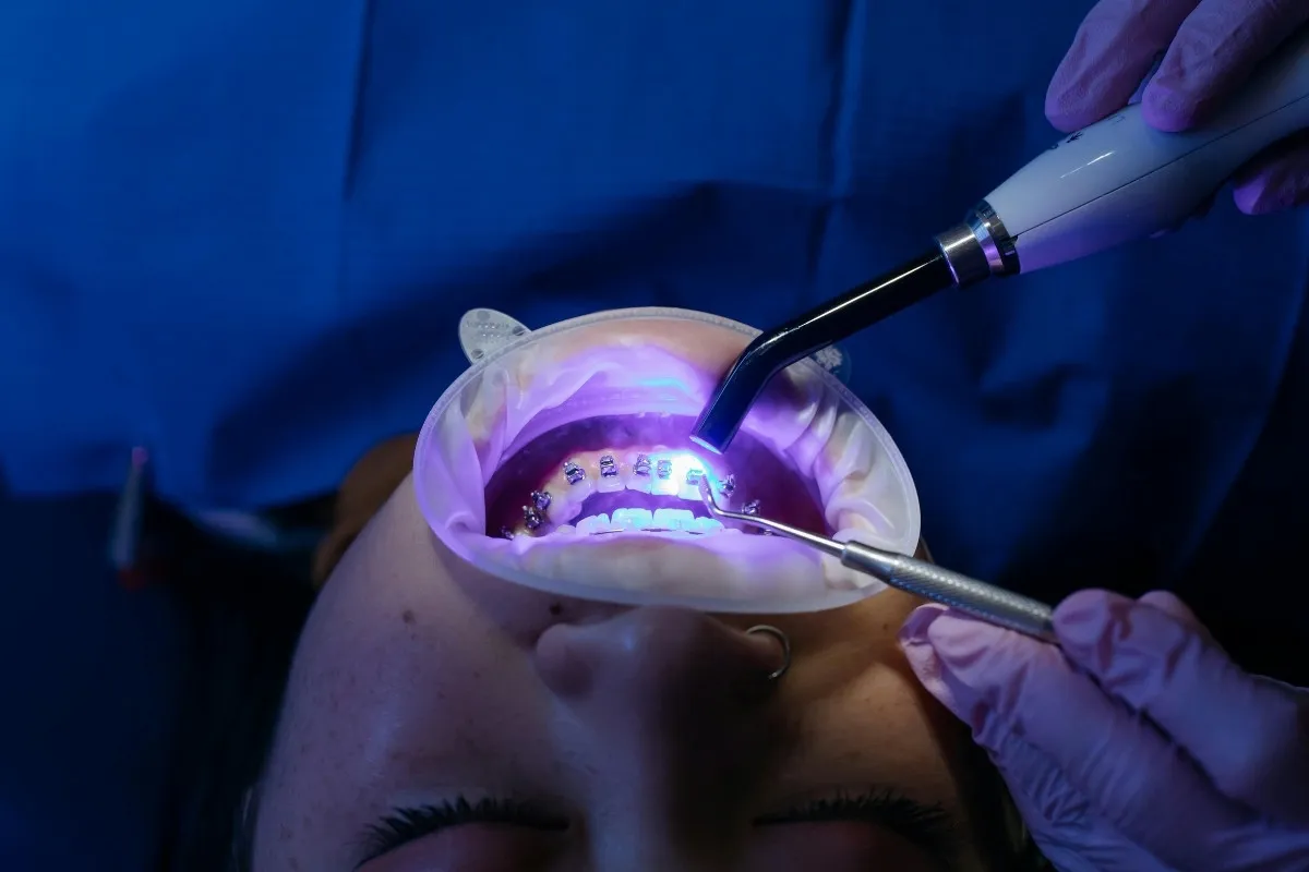 Dental Coverage: Does Medicaid Cover Braces in Florida?