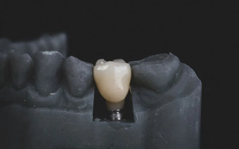 Does Medicaid Cover Dental Implants