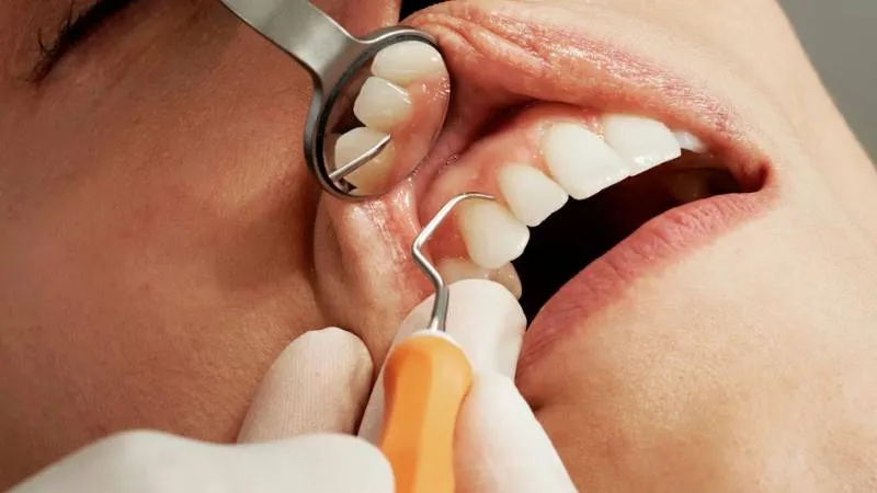 does-medicaid-cover-root-canals-1
