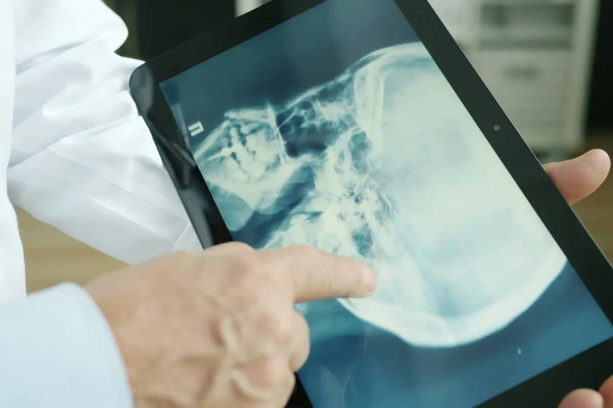 Does Medicaid Cover TMS Therapy? Approval Rules, State Differences, and Hidden Requirements in 2026