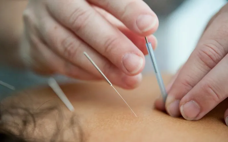 does-medicare-cover-acupuncture-what-you-pay