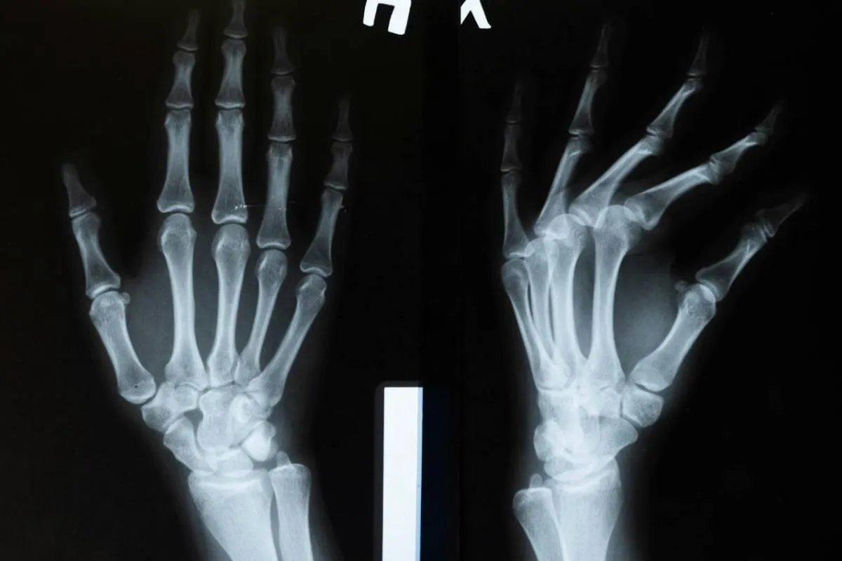 Does Medicare Cover Bone Density Test? Important Coverage Rules to Know