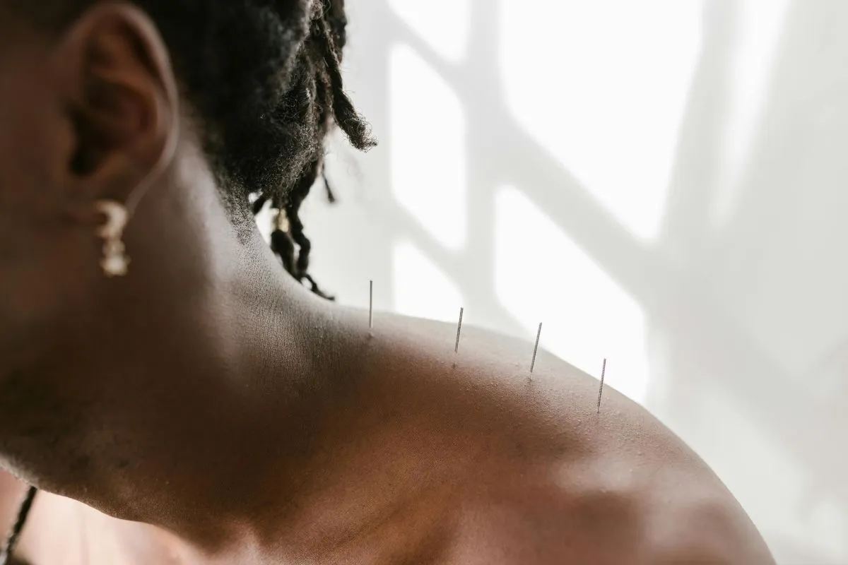 Does Medicare Pay For Acupuncture for Any Treatments?