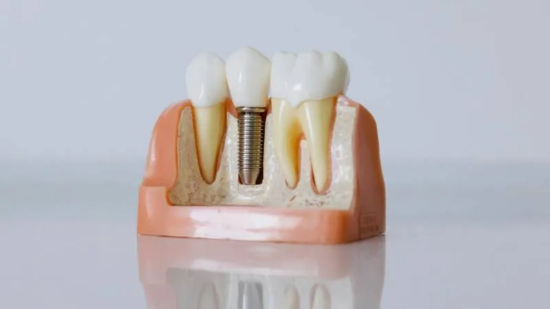 free-dental-implants-for-seniors-on-medicare-1