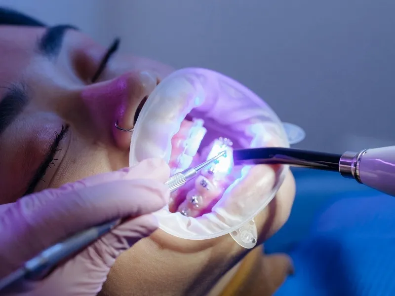 does medicaid cover braces in florida